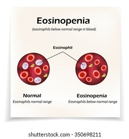 Eosinophils below normal range  in blood. Eosinopenia. Infographics. Vector illustration.