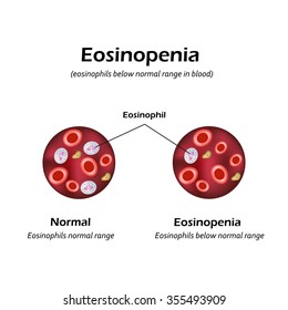 Eosinophils below normal range  in blood. Eosinopenia. Infographics. Vector illustration.