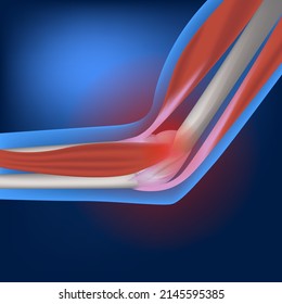 Epicondylitis of the elbow joint. inflammatory and degenerative lesion of soft tissues. Orthopedic pathology. Vector illustration