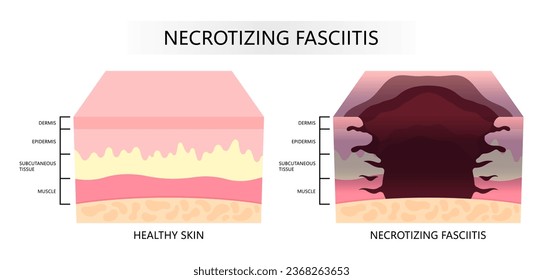 Epidermis layer of the skin with bacteria Necrotizing fasciitis infection cause pain limb leg with scab fat cancer care in medical