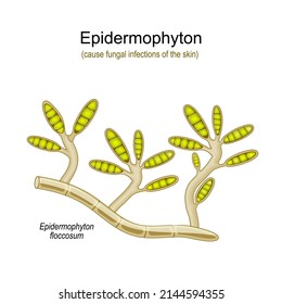 Epidermophyton Floccosum Fungal Infections Skin Vector Stock Vector ...