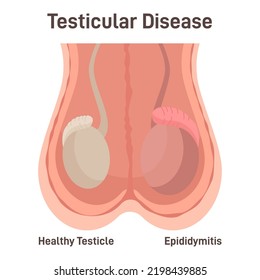 Epididymitis. Inflammation Of The Coiled Tube At The Back Of The Testicle. Male Reproductive Organ Disease. Flat Vector Illustration