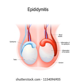Epididymitis is inflammation of the epididymis of the testicle. Illustration of an adult human testicles. Vector diagram for science and medical use. 