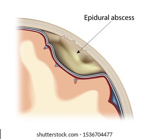 Epidural abscess of the human brain. Visual image of the location of the focus of infectious inflammation. Isolated on a white background. Vector graphics.