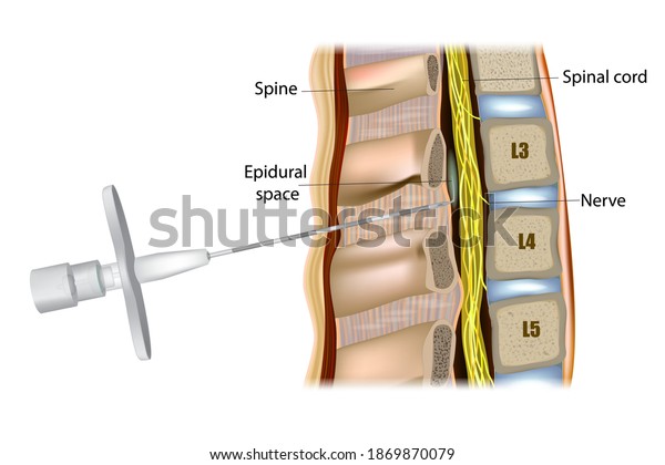 Epidural administration or Epidural anesthesia.\
Medicine is injected into the epidural space around the spinal\
cord. Tuohy Epidural\
Needle.