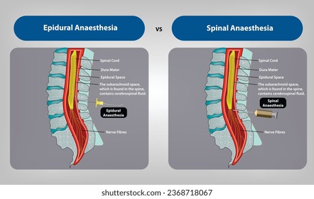 anestesia epidural vs anestesia espinal Vector e Ilustración