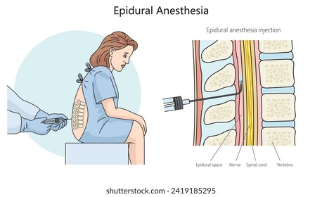 epidural anesthesia diagram hand drawn schematic vector illustration. Medical science educational illustration