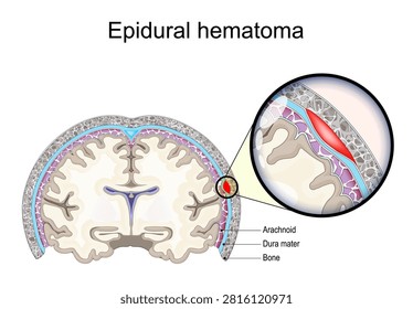 Epidural hematoma. Blood accumulation between skull and dura mater. Cross section of human brain. Neurology. Types of Intracranial Hemorrhage. medical infographic diagram. Vector illustration. 
