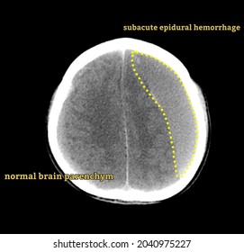 Epidural Hemorrhage Brain Ct Scan Vector Radiology