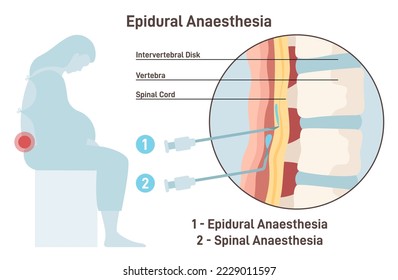 Anestesia epidural y espinal. Anestesia laboral de la mujer embarazada. Ilustración vectorial plana