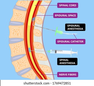 Epidural spinal block anaesthesia Pinched relieve General vaginal medical steroid Natural surgery Walking opioids baby pain back cord birth labor women local spine space relief labour section giving