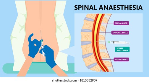 Epidural spinal block anaesthesia Pinched relieve General vaginal medical steroid Natural surgery Walking opioids baby pain back cord birth labor women local spine space relief labour section giving