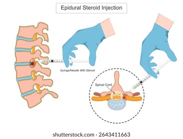 Epidural steroid injection is a medical procedure where corticosteroids and a local anesthetic is injected into the epidural space of the spine to relieve pain.Medical Healthcare, vector illustration.