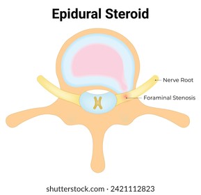 Epidural Steroid Science Design Vector Illustration Diagram