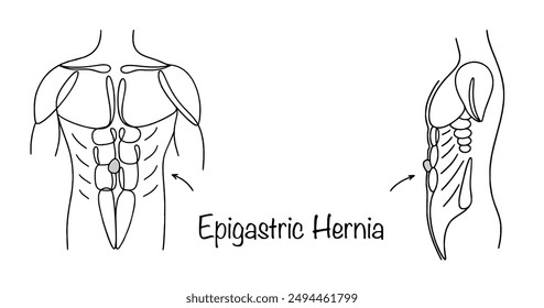 Epigastric Hernia. Hand-drawn torso of a man with a hernia. Protrusion in the midline of the anterior abdominal wall. Vector illustration for different uses.