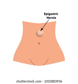 An epigastric hernia. intestinal hernia. Infographics. Vector illustration on isolated background