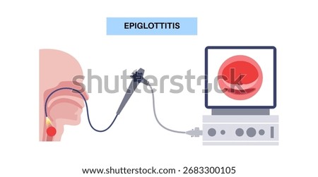 Epiglottitis stroboscopy procedure. An acute inflammation of the epiglottis, caused by bacterial infection such as Haemophilus influenzae. Swelling, airway obstruction, stridor, dyspnea medical vector