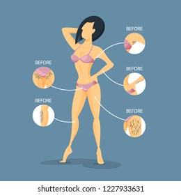 Epilation before and after. Armit and bikini zone hair removal with epilator. Body beauty care. Isolated flat vector illustration