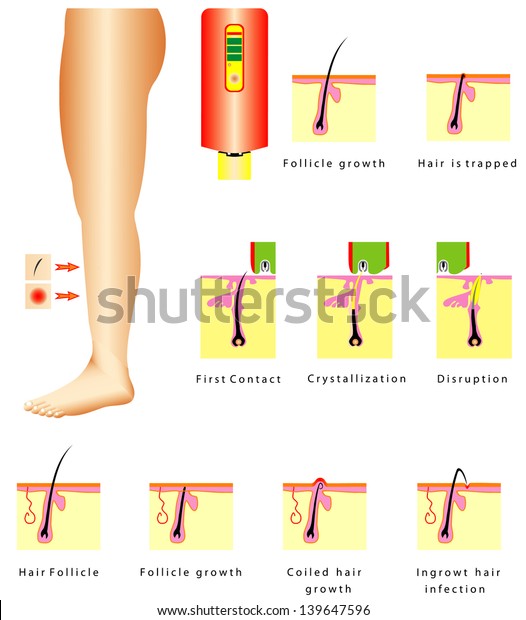 Epilation Ingrown Hair Infection Coiled Hair Stock Vector Royalty