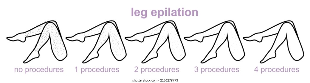 epilation zones of the legs, legs epilation, number of procedures, hair removal, women's legs, stages of laser hair removal of legs completely, smooth skin