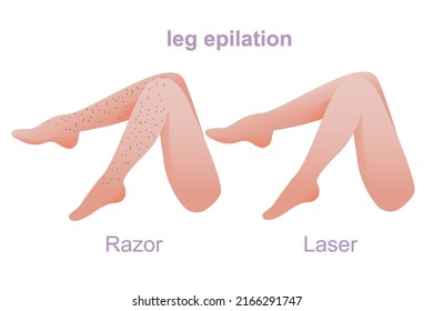 epilation zones of the legs, legs epilation, number of procedures, hair removal, women's legs, stages of laser hair removal of legs completely, smooth skin