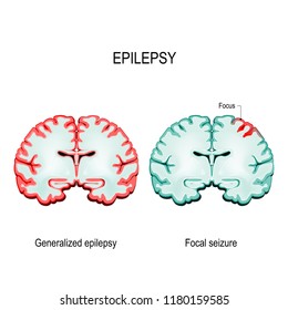 Epilepsy. Brain Sections. Primary Generalized Epilepsy And Focal Seizures. Vector Diagram For Educational, Medical, Biological And Science Use