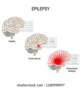 Epilepsy is a condition characterized by recurrent and unpredictable seizures. Human brain. EEG of healthy brain and epileptic seizure. primary generalized epilepsy and focal seizures.