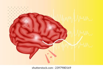 Epilepsy - A Neurological Condition - Stock Illustration as EPS 10 File