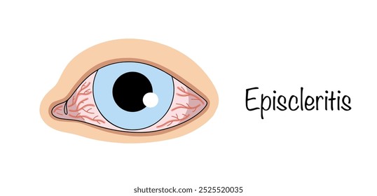 Episcleritis. Lesión inflamatoria de la capa externa de la esclerótica. Inflamación recurrente autocurativa de la esclerótica. Ilustración con enrojecimiento dentro del ojo. Ilustración vectorial.