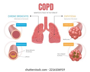 Epoc infographic: manifests itself in two forms emphysema and bronchitis 