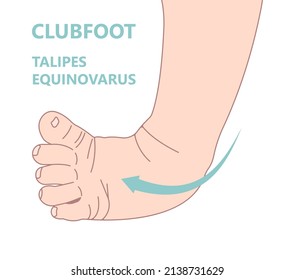 Equinovarus W Sit Injury Bow Leg Genu Valgum Varum Flat Duck Out Turn Inward Varus Club Skew Birth In Toeing Child Baby Kids Knock Knees Slew Foot Valgus Ankle Palsy Hip Pain