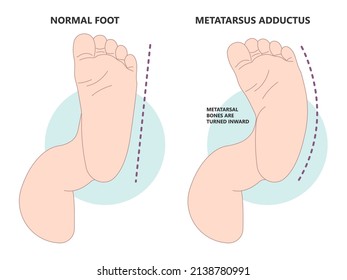 Equinovarus W sit injury bow leg genu valgum varum flat duck out turn inward varus club skew birth in toeing child baby kids knock knees slew foot valgus ankle palsy hip pain