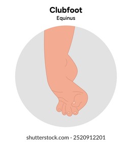 Equinus Clubfoot problema pé. Diagrama infográfico ortopédico