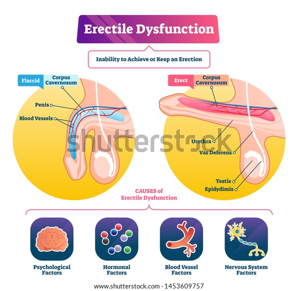 勃起不全のベクターイラスト ラベルと無力な説明スキーム 性的な男性の問題を伴う医療病 稔性能の問題と弛緩性陰茎疾患 海綿体浮上状態 のベクター画像素材 ロイヤリティフリー