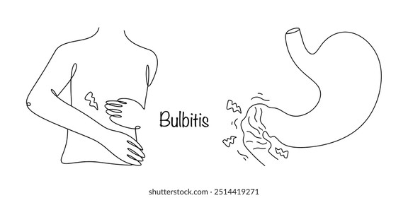 Inflamação erosiva ou catarral que afeta a parte bulbar do intestino. Inflamação desenhada à mão do bulbo duodenal. Ilustração de vetor médico para diferentes usos.