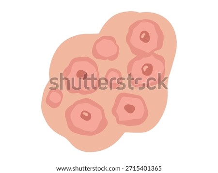 Erythema Multiforme Redness Clip Art