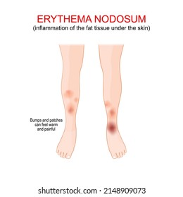 Erythema Nodosum. Inflammation Of The Fat Tissue Under The Skin. Bumps And Patches That Feel Warm, Painful And Firm. Vector Illustration