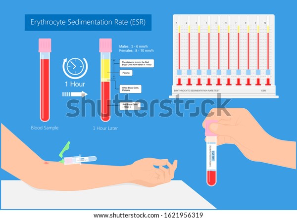 erythrocyte-sedimentation-rate-test-esr-inflammation-stock-vector