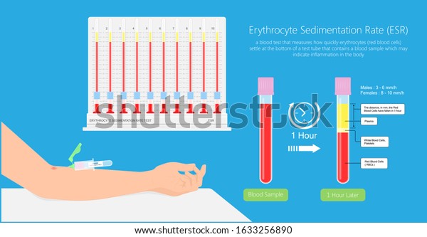 Erythrocyte Sedimentation Rate Test Esr Inflammation Stock Vector ...