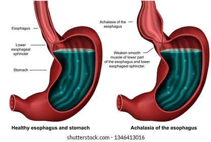 Esophageal Achalasia 3d Medical Vector Illustration On White Background