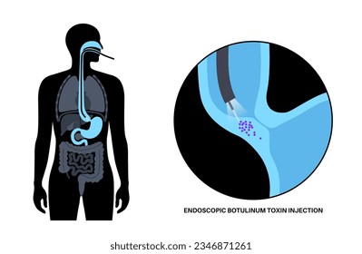 Esophageal achalasia disease, botulinum toxin injection treatment. Failure of smooth muscle fibers to relax. Gastrointestinal tract disorder. Closed lower esophageal sphincter, digestive system vector