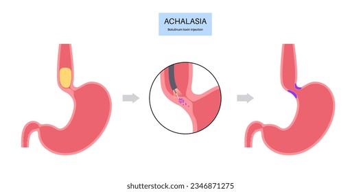 Esophageal achalasia disease, botulinum toxin injection treatment. Failure of smooth muscle fibers to relax. Gastrointestinal tract disorder. Closed lower esophageal sphincter, digestive system vector