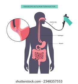 Enfermedad de acalasia esofágica, tratamiento de inyección de toxina botulínica. Fallo de las fibras musculares lisas para relajarse. Trastornos del tracto gastrointestinal. Esfínter esofágico inferior cerrado, vector del sistema digestivo