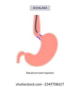 Esophageal achalasia disease, botulinum toxin injection treatment. Failure of smooth muscle fibers to relax. Gastrointestinal tract disorder. Closed lower esophageal sphincter, digestive system vector