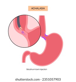 Esophageal achalasia disease, botulinum toxin injection treatment. Failure of smooth muscle fibers to relax. Gastrointestinal tract disorder. Closed lower esophageal sphincter, digestive system vector