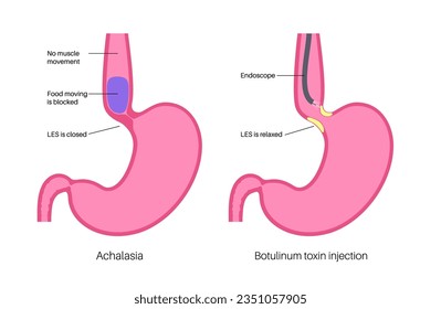 Esophageal achalasia disease, botulinum toxin injection treatment. Failure of smooth muscle fibers to relax. Gastrointestinal tract disorder. Closed lower esophageal sphincter, digestive system vector