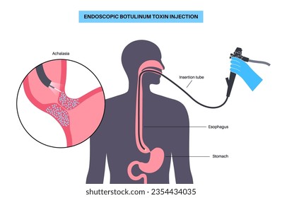 Ösophagusachalasien, Behandlung mit Botulinumtoxin. Versagen der glatten Muskelfasern zu entspannen. Erkrankungen des Gastrointestinaltrakts. Geschlossener Unterhautsophagealer Sphinzer, Verdauungsvektor