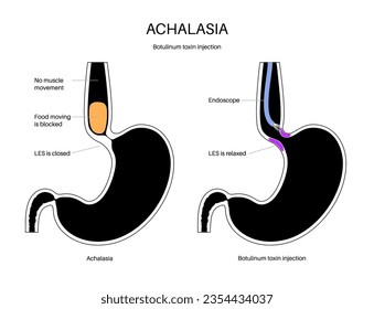 Esophageal achalasia disease, botulinum toxin injection treatment. Failure of smooth muscle fibers to relax. Gastrointestinal tract disorder. Closed lower esophageal sphincter, digestive system vector