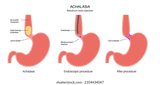 Esophageal achalasia disease, botulinum toxin injection treatment. Failure of smooth muscle fibers to relax. Gastrointestinal tract disorder. Closed lower esophageal sphincter, digestive system vector