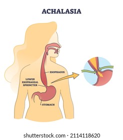 Esophageal Achalasia Disease With Lower Sphincter Opening Failure Outline Diagram. Labeled Educational Smooth Muscle Fibers Condition Explanation With Failed Valve Closure Symptoms Vector Illustration